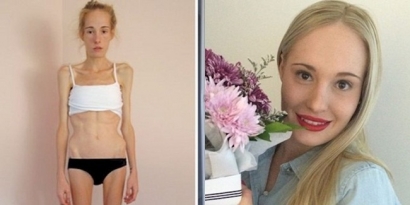 Hampir Meninggal Karena Anoreksia, 7 Tahun Kemudian Gadis ini Kini Terlihat Cantik