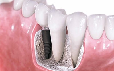 Implan Gigi Teknologi Gigi Palsu yang Paling Mirip dengan Gigi Asli