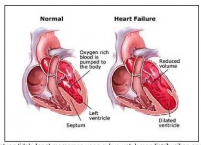 Memelihara Kesehatan Bagi Pasien Gagal Jantung
