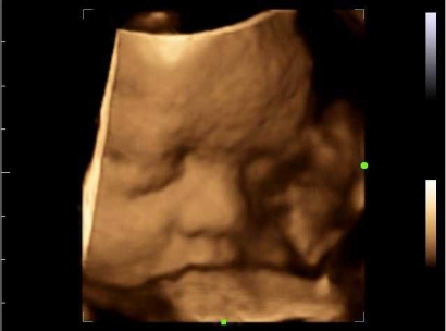 USG 4 Dimensi Kehamilan