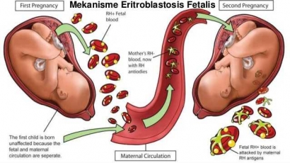 Penyebab "Eritroblastosis Fetalis" dan Bagaimana Solusi Pencegahannya