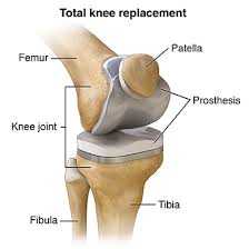 Kenapa Harus Melakukan Pergantian Lutut
