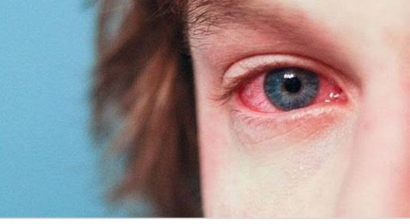 Jangan Salah Membedakan Alergi pada Mata dan Infeksi Mata
