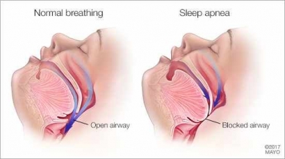 Cara Berhenti Mengorok (Terbukti Berhasil) | How to Stop Snore