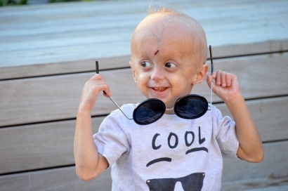 Progeria, Saya Tetap Bahagia untuk Mengubah Dunia