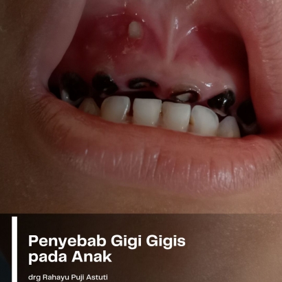 Penyebab Gigi Gigis pada Anak