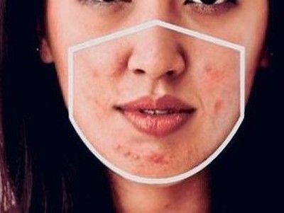 Mask Acne: Si Kecil Menggemaskan, Penyebab dan Cara Mengatasinya