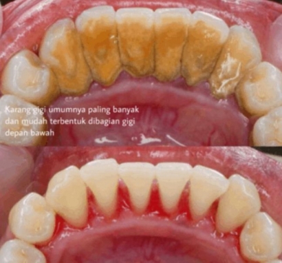 5 Tips Hilangkan Karang Gigi