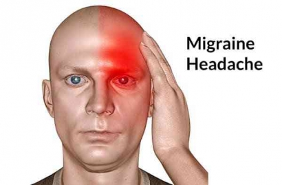 Kenali Migrain yang Sering Dipandang sebagai Sakit Kepala Biasa