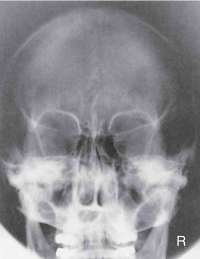 Pemeriksaan Radiografi Skull Caldwell