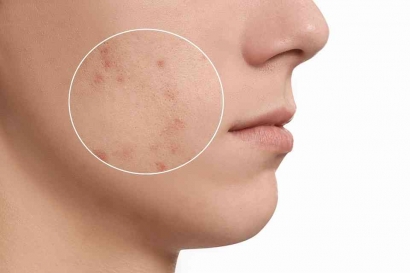 Skincare 101: Tips Memudarkan Bekas Jerawat Hitam di Kulit Wajah