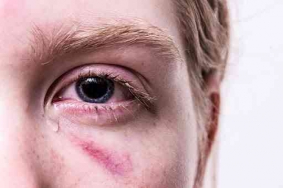10 Penyakit Mata Mulai dari yang Paling Umum serta Gejalanya