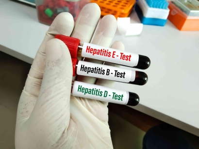 Mengenal Hepatitis: Ancaman Tersembunyi di Balik Kesehatan Hati