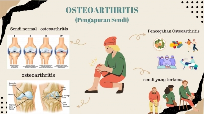 Osteoarthritis (Pengapuran sendi) Mengancam Produktivitas Masa Tua