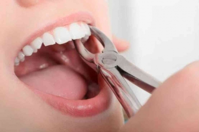 Apakah Aman Mencabut 5 Gigi Sekaligus?