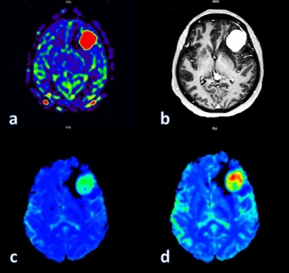 MRI Perfusi: Inovasi Terkini Deteksi Meningioma Lebih Cepat dan Akurat