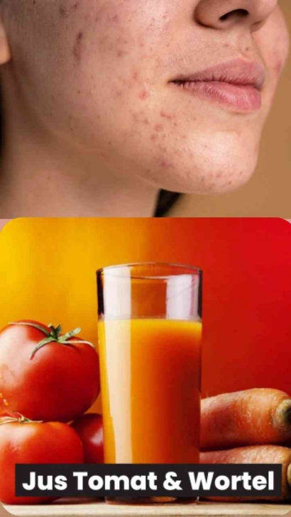 Ampuh Banget, Hanya Minum Jus Tomat+Wortel Bisa Menghilangkan Jerawat?