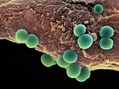 Yuk, Kenali Bakteri Staphylococcus Aureus yang Paling Banyak Ditemukan pada Area Behel