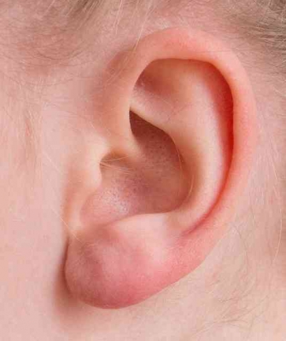 Cara Membersihkan Kotoran Telinga dengan Aman untuk Kesehatan Pendengaran Optimal