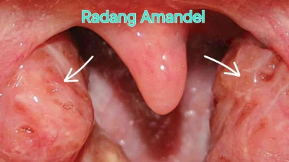 Radang Amandel (Tonsilitis), Apakah Perlu Dioperasi?