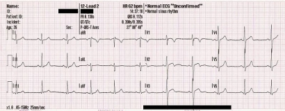 EKG, Deteksi Jantung Tanpa Ahli Jantung ?