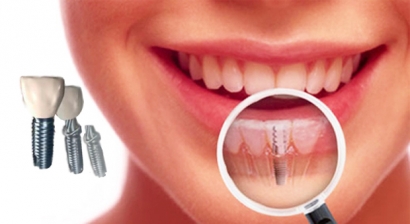 Apakah Implan Gigi Aman Untuk Kesehatan